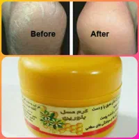 ترک پا عسل بلورین