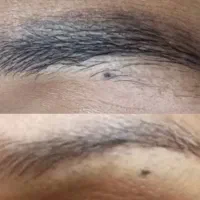 ریموو(پاک کردن تاتو) صورت وبدن با لیزر پیشرفته|خدمات آرایشگری و زیبایی|تبریز, |دیوار