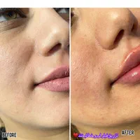 جشنواره تزریق ژل و بوتاکس (تحت نظرپزشک)|خدمات آرایشگری و زیبایی|اصفهان, خلجا|دیوار