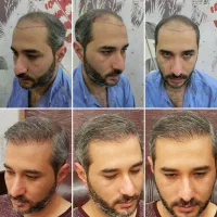 کاشت مو طبیعی سر و ابرو|خدمات آرایشگری و زیبایی|تهران, قیطریه|دیوار
