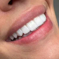 جشنواره دندانپزشکی کامپوزیت دندان عصبکشی و روکش