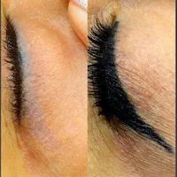 تکنیک ریموو تاتوهای قدیمی صورت و خاویارتراپی