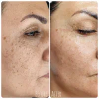 رفع لک ها و روشن سازی پوست|خدمات آرایشگری و زیبایی|اصفهان, مفتح|دیوار