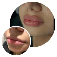 آف ژل وبوتاکس