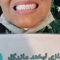 دندان مصنوعی دندانسازی با ضمانت