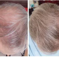 با کچلی خدافظی کن