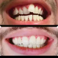 ارتودنسی اقساطی باکیفیت بالا پایین تر از نرخ دولتی