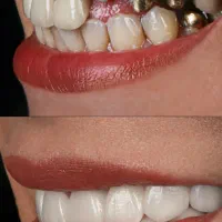 دندانپزشکی اقساطی بدون پیش پرداخت ایمپلنت کامپوزیت|خدمات آرایشگری و زیبایی|خرم‌آباد, |دیوار