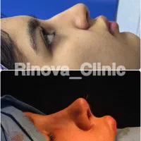 جشنواره جراحی زیبایی بینی فقط52