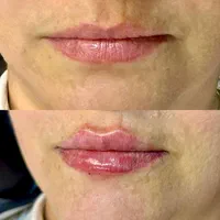 فیلر لب/کانتورینگ کامل صورت /فیلر بکینی/بوتاکس|خدمات آرایشگری و زیبایی|اصفهان, گلزار|دیوار