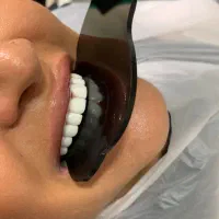 /کامپوزیت /لمینت / دنتال الماس|خدمات زیبایی و سلامت|کرج, کمال‌شهر|دیوار