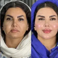 تزریق ژل و فیلر لب،گونه،چانه(جشنواره)درمطب فقط499ت|خدمات آرایشگری و زیبایی|اصفهان, باغ زیار|دیوار