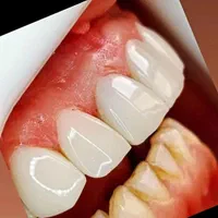 کامپوزیت دندان آلفا