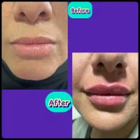 بوتاکس/پی آر پی/ژل لب/لیزر /مسکن|خدمات آرایشگری و زیبایی|کرمانشاه, |دیوار