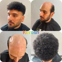 نصب پروتزمو/تعویض چسب پروتزمو/ترمیم/درمحل/وسالنvip|خدمات زیبایی و سلامت|تهران, فلسطین (میدان انقلاب)|دیوار