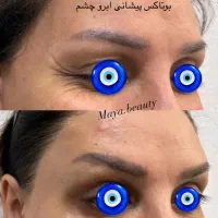 تزریق ژل فیلر بوتاکس تخفیف پاییزی|خدمات آرایشگری و زیبایی|اصفهان, مرداویج|دیوار