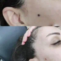 درمان کیست ملیا زیر چشم و برداشتن خال و زگیل|خدمات آرایشگری و زیبایی|نیشابور, دارایی|دیوار