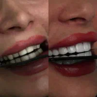 دندون پزشکی اقساطی کامپوزیت اقساطی 12 ماهه|خدمات آرایشگری و زیبایی|تهران, خانی آباد نو شمالی|دیوار