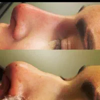 اف ویژه تزریق فیلر آنزیم و بوتاکس