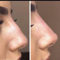 لیزرموهای زائد فول دست پا صورت ژل فیلربادی بوتاکس|خدمات آرایشگری و زیبایی|کرج, گوهردشت|دیوار