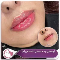 جشنواره تخفیفات 50% فیلر لب زیر چشم شقیقه دکترمقدم|خدمات آرایشگری و زیبایی|مشهد, هفت تیر (آب و برق)|دیوار