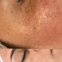 فشیال پاکسازی لیزر پوست جوانساز|خدمات آرایشگری و زیبایی|شیراز, معالی‌آباد|دیوار