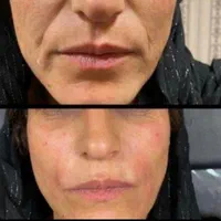 ژل لب و بوتاکس  مدلینگ پرسینگ چالگونه آموزش ژل|خدمات آرایشگری و زیبایی|اهواز, کیانپارس |دیوار