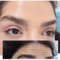 ژل وبوتاکس  در مطب پزشک