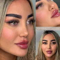 ۵۰ درصد تخفیف تزریق صورت سبک عربی هالیوودی لب روسی