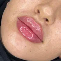 جشنواره ۵۰درصدی ژل و بوتاکس ، ساکشن غبغب|خدمات آرایشگری و زیبایی|کرمانشاه, |دیوار