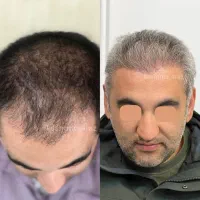 کاشت مو قسطی شد|خدمات آرایشگری و زیبایی|ملکان, |دیوار