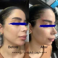 تزریق ژل و بوتاکس با قیمت باور نکردنی