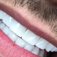 کامپوزیت از ۱م ایمپلنت دندان ۲۰م روکش.عصب کشی|خدمات زیبایی و سلامت|تهران, نارمک جنوبی|دیوار