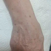 لیزر موهای زائدروشن کننده ورفع لک رفع منافذبوتاکس|خدمات آرایشگری و زیبایی|رشت, بوسار|دیوار