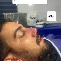 اف ویژه عمل بینی و تمام لاینهای زیبایی