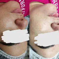 فیشال و پاکسازی تخصصی پوست بانوان