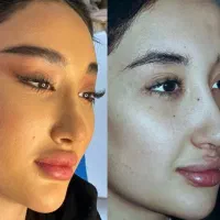 لیفت فول فیس صورت لیفت چشم گربه ای بدون عمل جراحی|خدمات آرایشگری و زیبایی|ری, دیلمان|دیوار