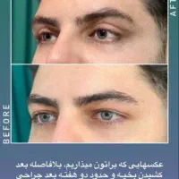 جراحی بلفاروپلاستی|خدمات آرایشگری و زیبایی|تهران, هفت حوض|دیوار