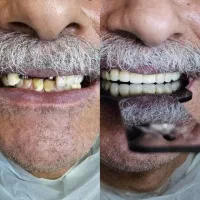 ایمپلنت ۸۵۰۰ و ۱۱،۴۰۰ با ضمانت واقساط|خدمات زیبایی و سلامت|تهران, شهرآرا|دیوار