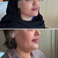 لیپو ساکشن بدن و غبغب