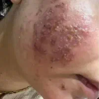 درمان جوش با هر منشایی