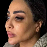 کاشت مو وزیبایی بدن اقساطی|خدمات آرایشگری و زیبایی|تبریز, |دیوار