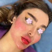 جشنواره ویژه ژل و بوتاکس|خدمات آرایشگری و زیبایی|اردبیل, |دیوار