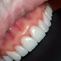 کامپوزیت ۴۰درصد تخفیف