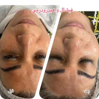 فیشال و نخ کلاژن به جای بوتاکس|خدمات آرایشگری و زیبایی|اصفهان, کوی ولی عصر|دیوار