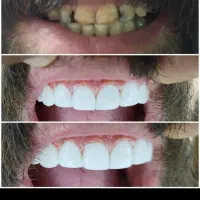 تخفیف پاییزه کامپوزیت،روکش