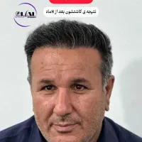 کاشت مو و ابرو|خدمات آرایشگری و زیبایی|قم, پامنار|دیوار