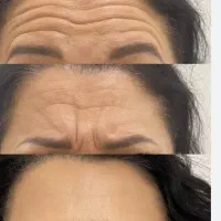 تزریق بوتاکس مصپورت و فیلر توسط پزشک فقط ۱ ملیون