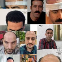فیلرصورت بوتاکس کربن هایفو لیزرمو ریموتتو جوانسازی|خدمات آرایشگری و زیبایی|یاسوج, |دیوار