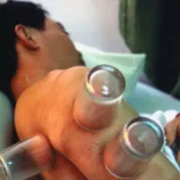 باد کش وحجامت